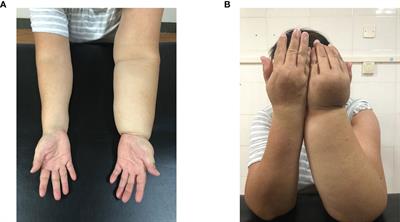 Revitalizing quality of life: a case report on the beneficial impact of comprehensive rehabilitation therapy in treating upper-limb lymphedema following breast cancer surgery